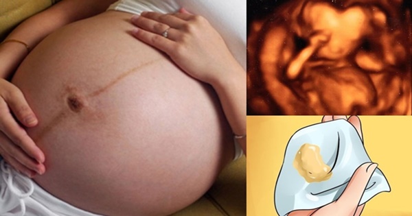 Khí hư ra nhiều khi mang thai có sao không? Đâu là cảnh báo nguy hiểm?