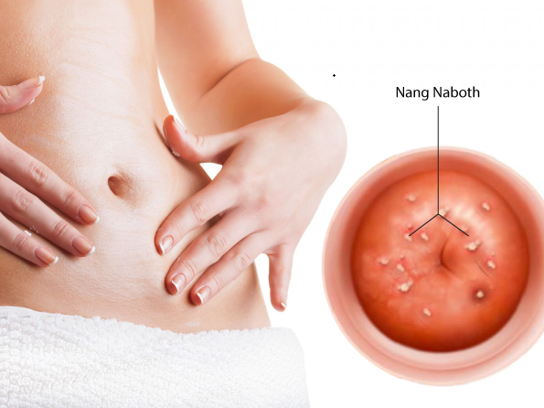Nang naboth cổ tử cung: Nguyên nhân, dấu hiệu và cách chữa trị