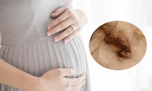 Ra khí hư màu nâu khi mang thai có ảnh hưởng gì tới thai nhi không?