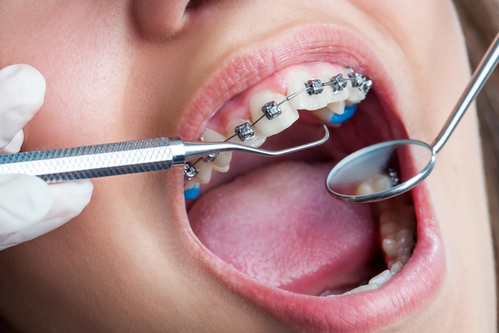 Niềng răng là gì? Thời gian niềng răng tối thiểu trong bao lâu?