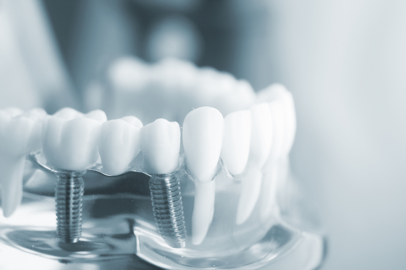 Trồng răng Implant có tốt không? Địa chỉ cấy ghép implant uy tín